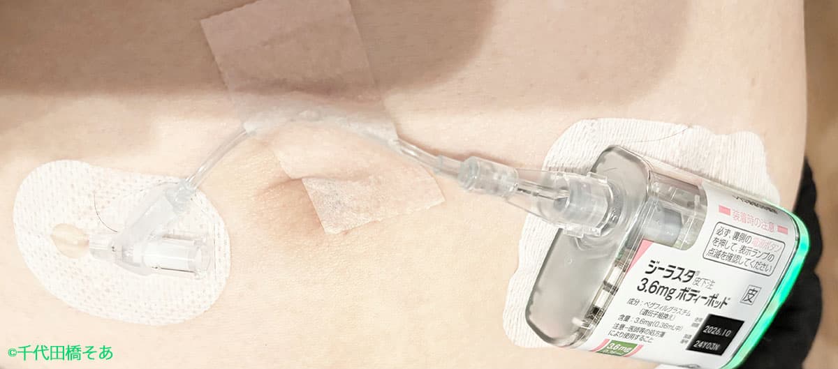 時限式でお腹に設置されるジーラスタ